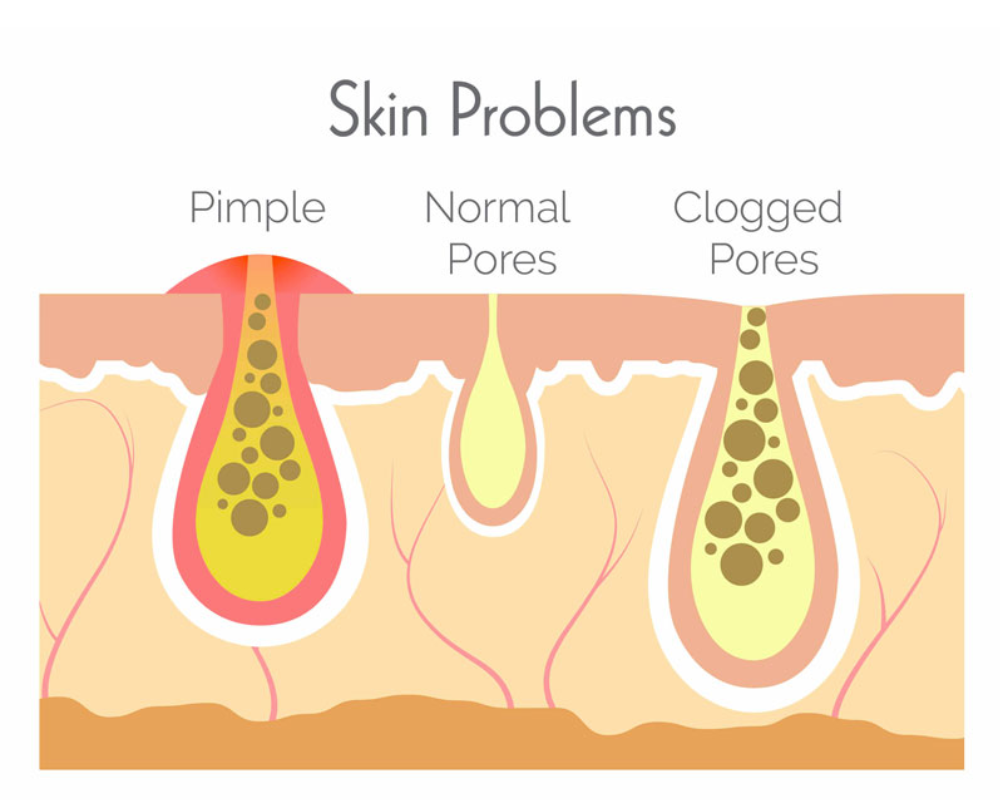 Bàn chải tắm Silicone Emmié: Giải pháp cho những vấn đề da phổ biến