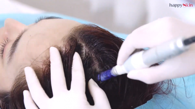 Kích mọc tóc bằng phương pháp PRP - Tế bào gốc tự thân