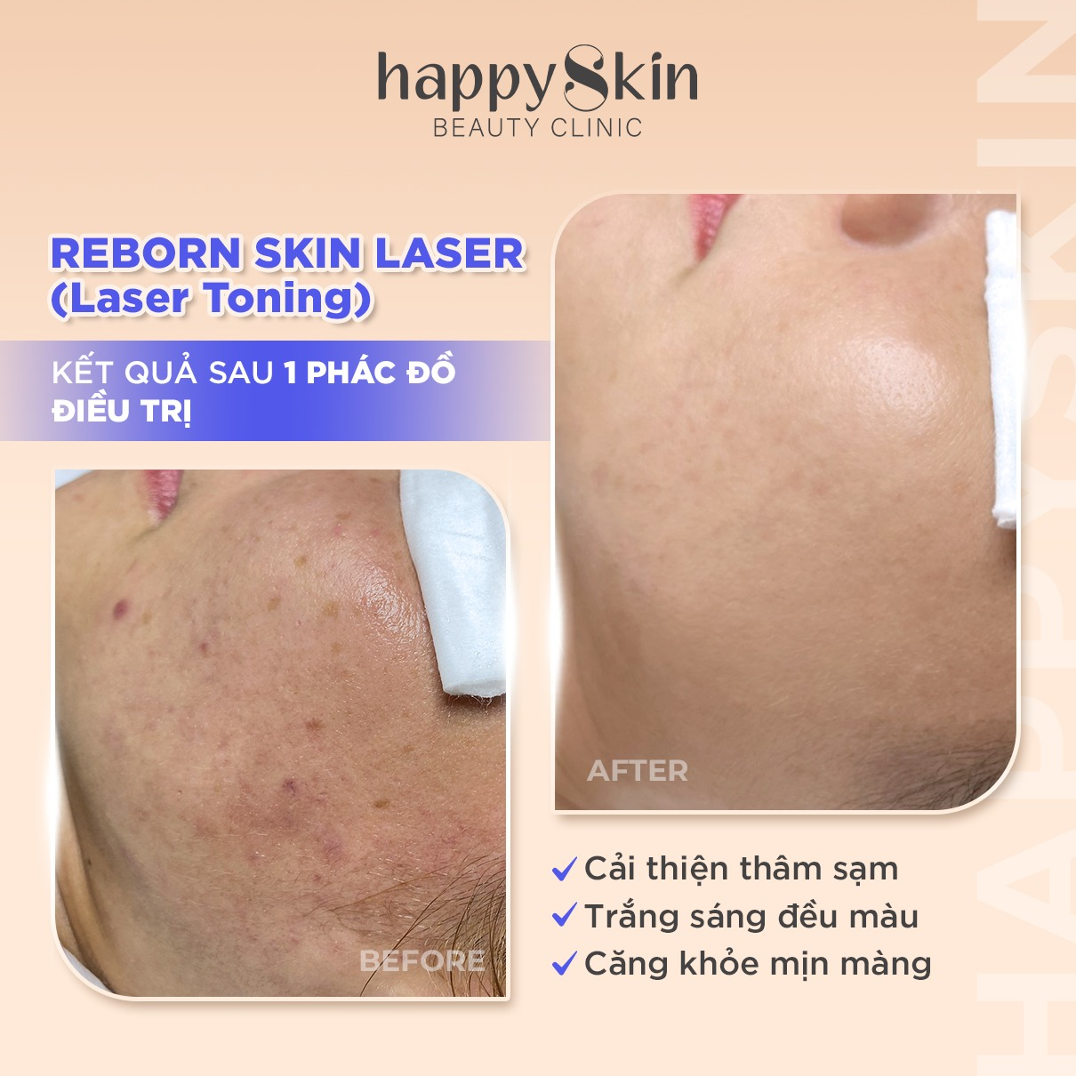 Hiệu quả sau khi sử dụng Liệu trình Reborn Skin Laser tại HappySkin Beauty Clinic
