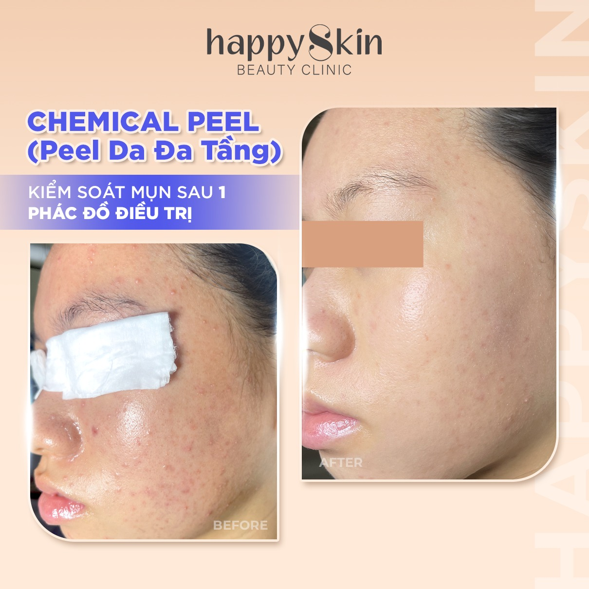 Hiệu quả sau khi sử dụng liệu trình peel da đa tầng tại HappySkin Beauty Clinic